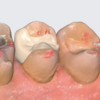 dentbirdの最新アップデート：ブリッジ・インレー機能の追加