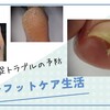 毎日の丁寧な【フットケア】で【巻き爪】などの足トラブルを予防！