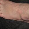 Bunions Causes Signs Or Symptoms And Solutions