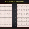 ECG-262：60才代男性。呼吸苦で倒れました。