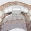 Medit Splints 1.1　アップデート　スプリント以外にも使えます！