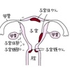 掲示板に子宮頚がんの質問があったので