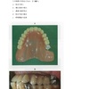 115回歯科医師国家試験【115B-38】キャップクラスプ編