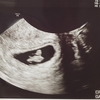 胎嚢確認（5w4d）から心拍確認（7w2d）