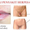 Cara menyembuhkan herpes di kelamin pria