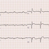 ECG-147：answer