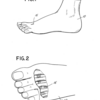 Treating Mortons Neuroma