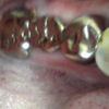 メタルコアによるブリッジ支台歯の歯根破折リカバリ