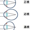 視力の成長と屈折異常、調節力の変化其の二（幼児期の視力矯正）