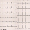 ECG-168：90才代女性。パッとしない心電図の解釈です。