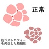 筋ジストロフィーに関する雑学