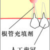 クラウンが... ３ 手術を受ける