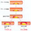 動脈血栓症と静脈血栓症の違い