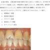 117回歯科医師国家試験【117B-53】歯冠補綴学：レジン前装冠の補修修復
