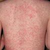 Các bệnh về da thường gặp trong mùa hè