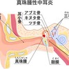 ★耳の中がゴソゴソする・・・➡真珠腫？！かもしれません。