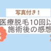 医療脱毛10回以上施術後の感想