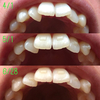 《120日目》今日から13枚目！歯並び比べる《12/30枚》