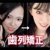 【約2年】30代女の歯列矯正が終了！メリットとデメリット！