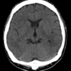 症例10：昏睡状態で発見された精神疾患を持つ男性（Ann Emerg Med. 2017 Sep;70(3):430-439.）