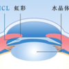 ICL手術後1週間検診