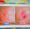 免疫を活性化させて、ガンの元の赤いシミを直す薬があるそうです。