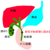 激痛！胆石で入院しました ERCP編 グロ注意！