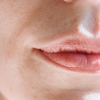 口唇ヘルペス、再発を防ぐには？原因と予防法を解説