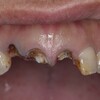 ほとんどの虫歯治療は取り切れていない？！