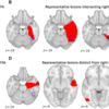 顔の認知に関わるネットワーク：相貌認知のlesion network mapping