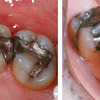 Răng sâu bị vỡ lớn có khắc phục bằng trám răng được không ?
