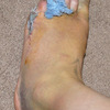 Hammertoe