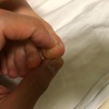 足の親指の爪の部分が痛いのを治す