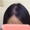 【スーパースカルプ発毛センター/比較写真】通ってるお店はここです【仙台泉店】
