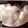  (5週0日) 胎嚢確認 