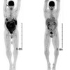 悪性リンパ腫のミミックとなるMyeloid Sarcoma