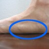 Causes Of Acquired Flat Foot Deformity