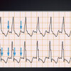 ECG-158：answer