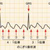 心房粗動と心房頻拍の違い