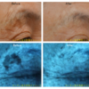 ピコレーザー（エンライトンⅢ）でシミ取りをしました。肌診断マシーンでもとれていることがわかります。