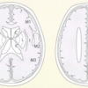 早期虚血性変化の評価方法（ASPECTS）