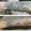 ピコレーザーでタトゥー除去をしています。1回治療後（治療後1か月後）です。前腕ぐるっと一周あります。