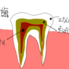 歯のつめものが取れたら即歯医者さんに行こう！