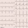 ECG-207：70才代女性。めまいと息切れでした。