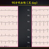 ECG-317：answer 