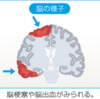 血管性認知症とは