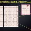 ECG-202：answer