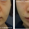ほうれい線やマリオネットラインが綺麗にリフトアップ。クリスタルリフトを行いました。