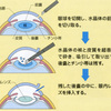 『白内障』の事。その４