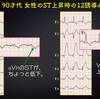 ECG-222：answer